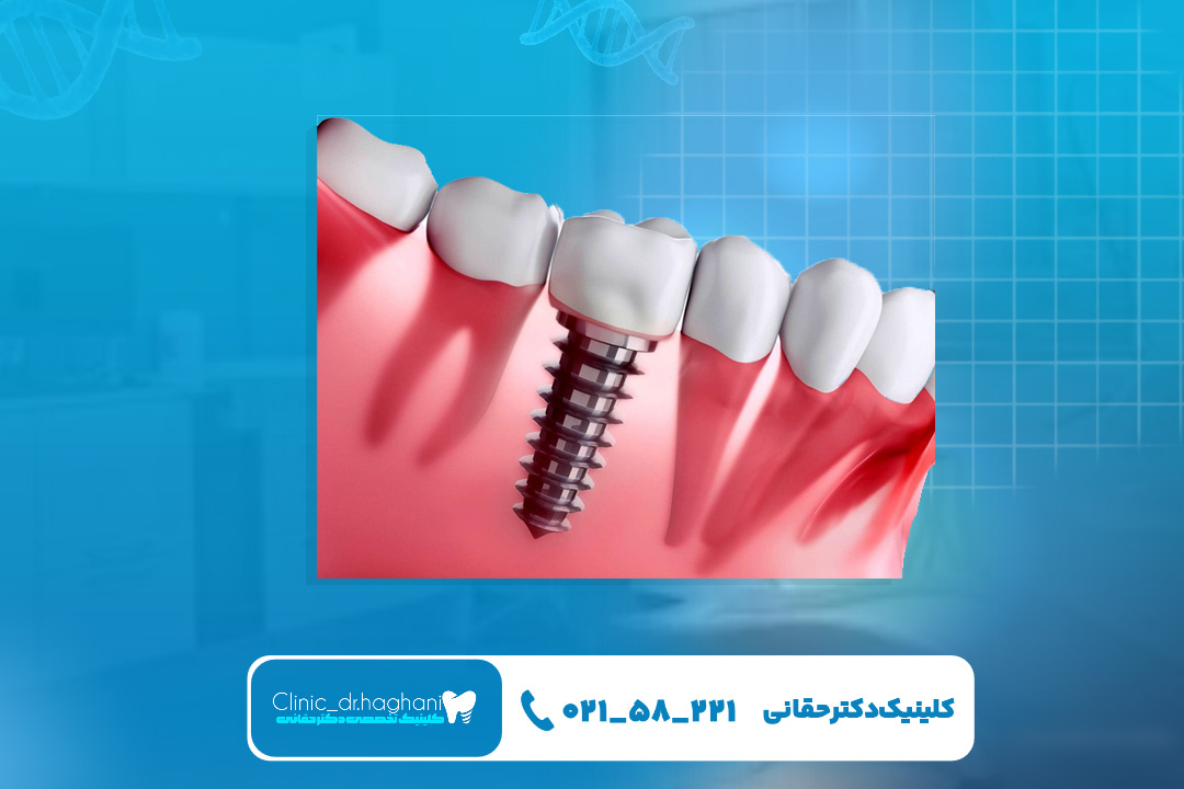 بهترین ایمپلنت دندان