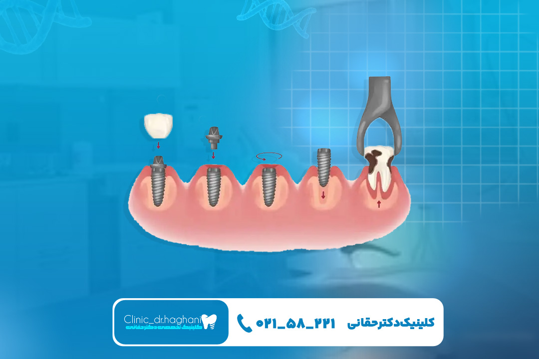 هزینه ایمپلنت دندان