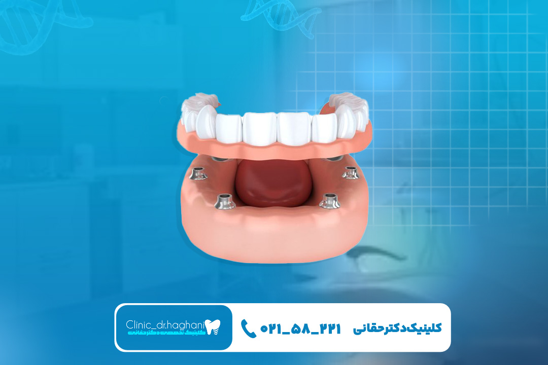 هزینه ایمپلنت دندان