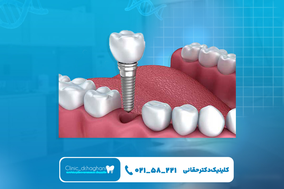هزینه ایمپلنت دندان