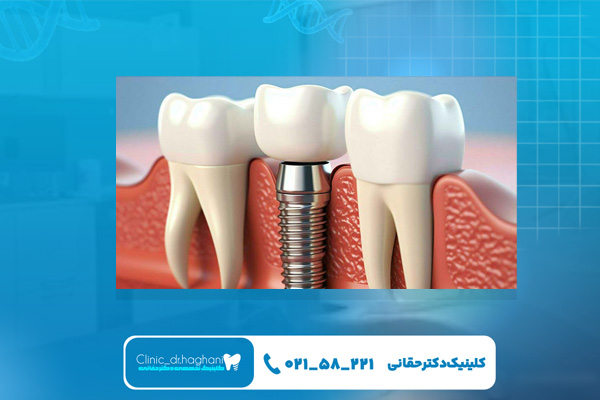 ایمپلنت دندان در مرکز تهران ایمپلنت دندان در مرکز تهران