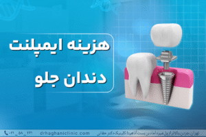 هزینه ایمپلنت دندان جلو