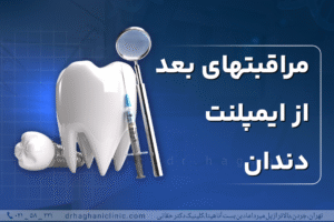 مراقبت های بعد از ایمپلنت‌ دندان