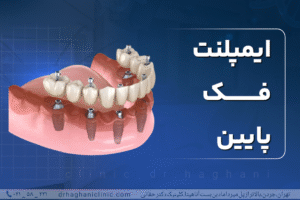 ایمپلنت فک پایین