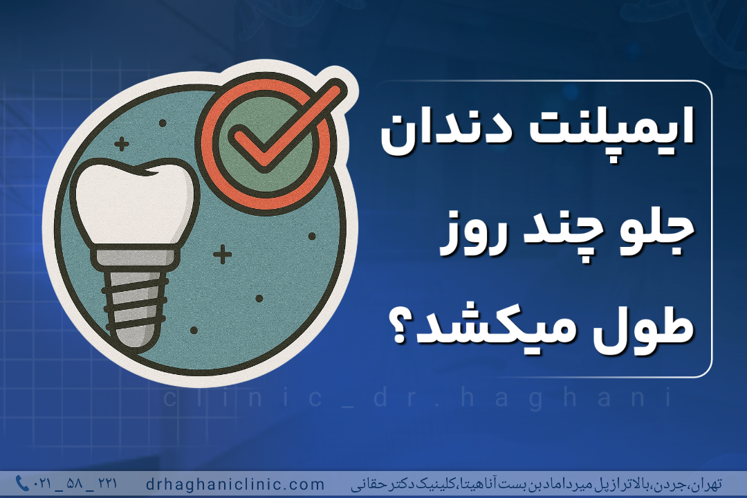 ایمپلنت دندان جلو چند روز طول میکشد؟