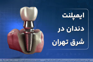 ایمپلنت دندان در شرق تهران