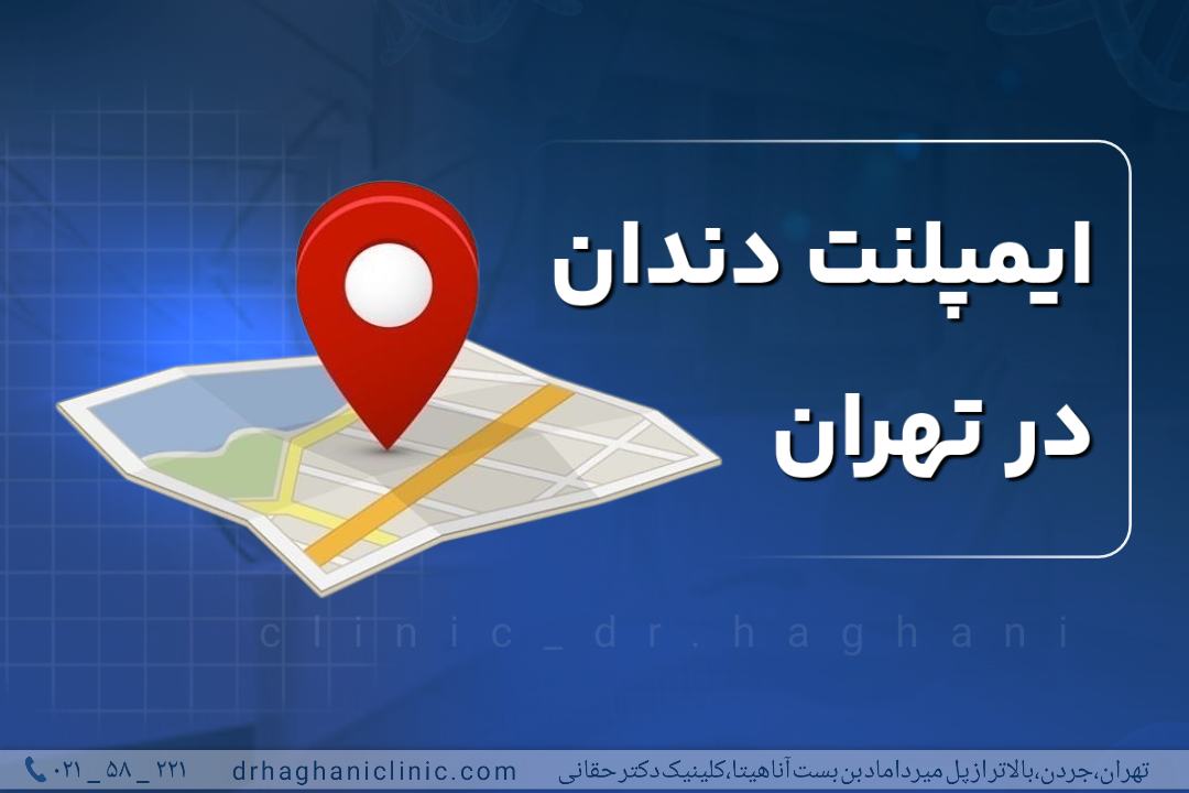 ایمپلنت دندان در تهران