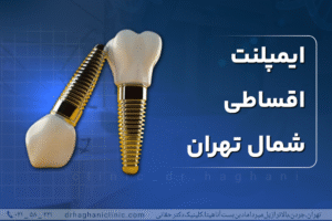 ایمپلنت اقساطی شمال تهران