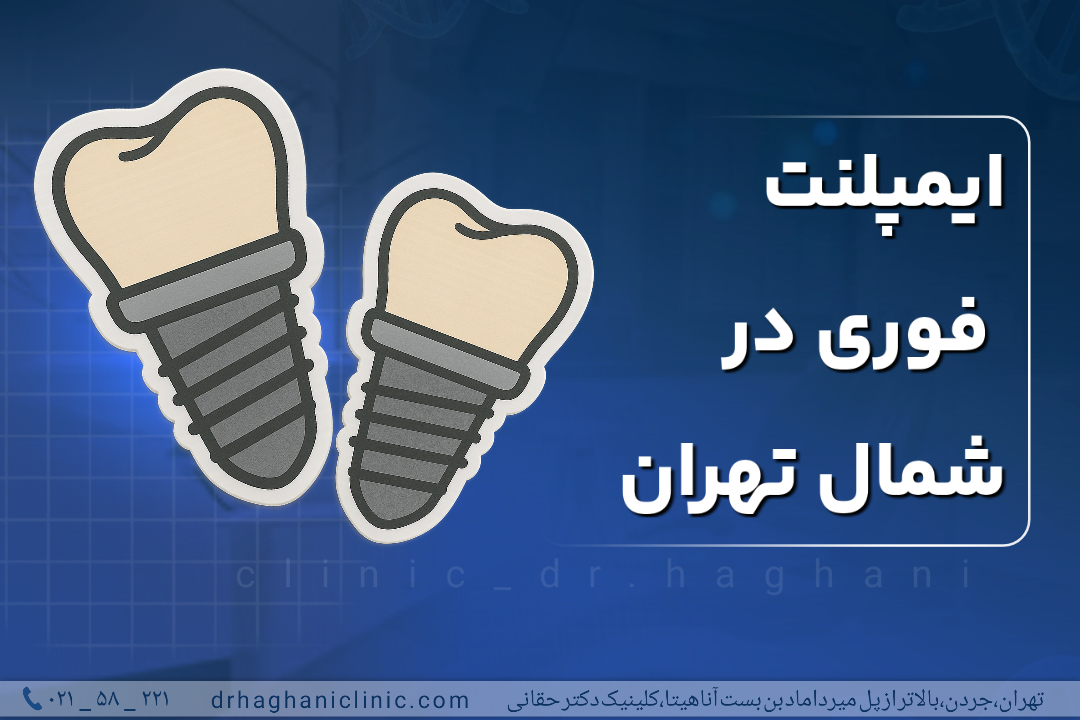 ایمپلنت فوری در شمال تهران