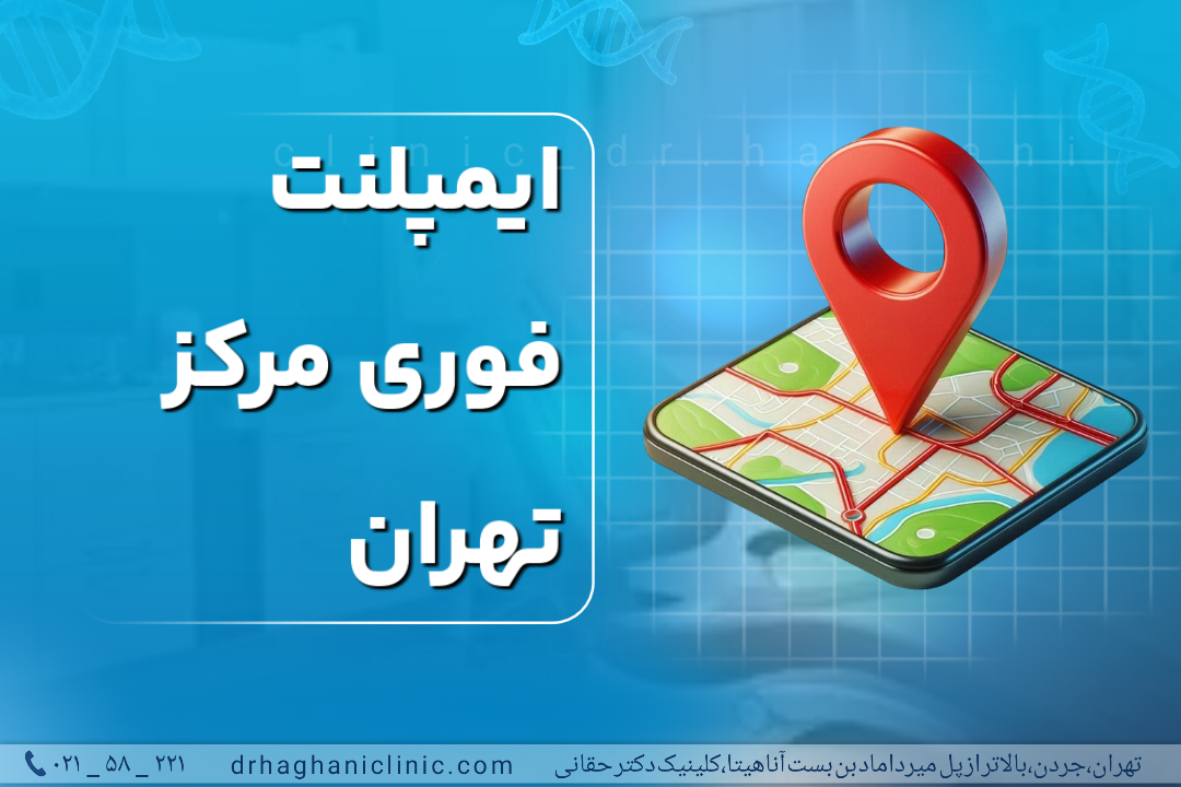 ایمپلنت فوری مرکز تهران