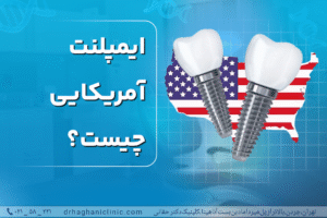ایمپلنت آمریکایی چیست
