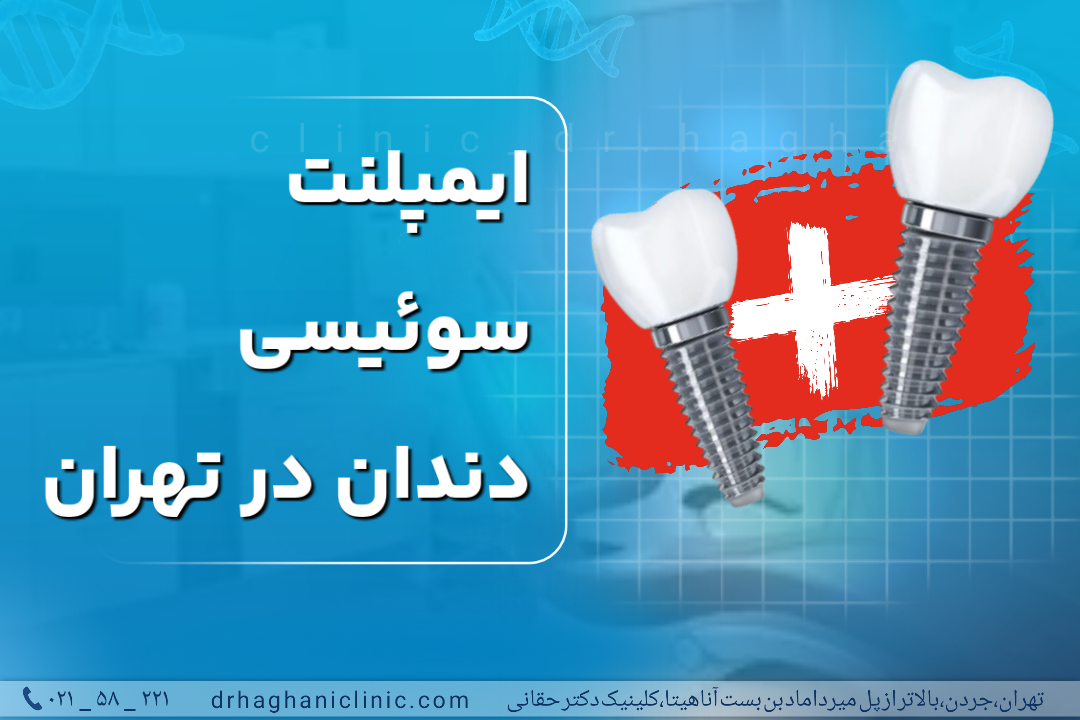 ایمپلنت سوئیسی دندان در تهران