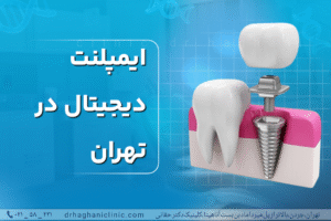 ایمپلنت دیجیتال در تهران