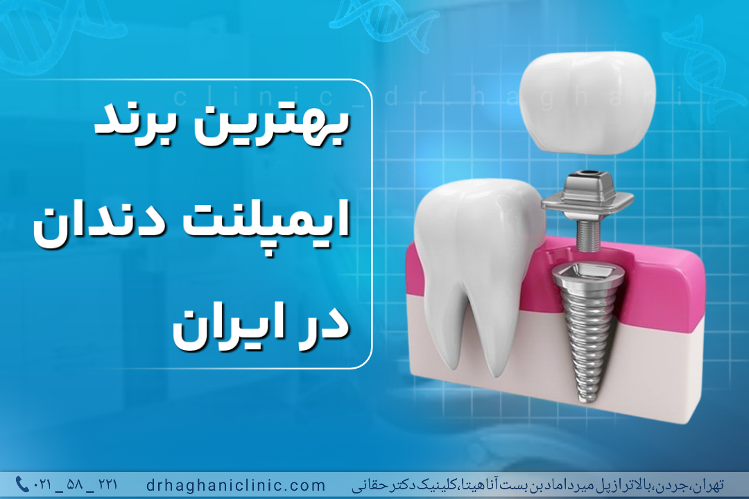 بهترین روش کاشت ایمپلنت در ایران