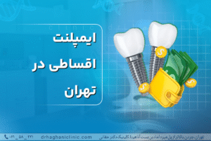 ایمپلنت اقساطی در تهران