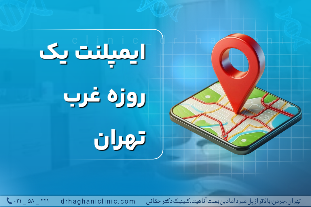 ایمپلنت یک روزه غرب تهران