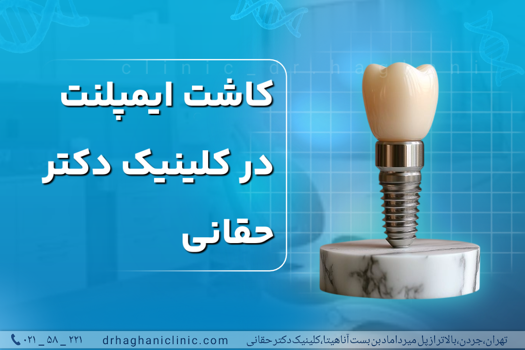کاشت ایمپلنت در کلینیک دکتر حقانی