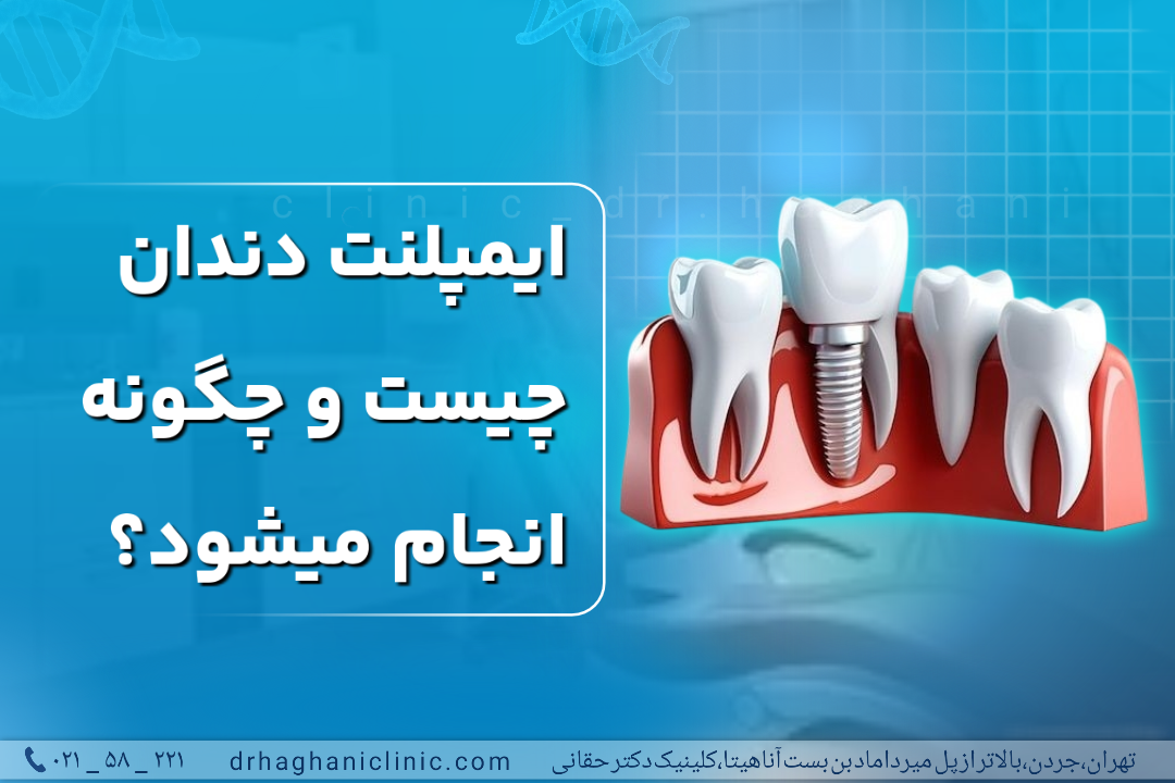 ایمپلنت دندان چیست و چگونه انجام می شود