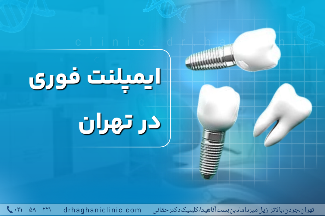 ایمپلنت فوری در تهران