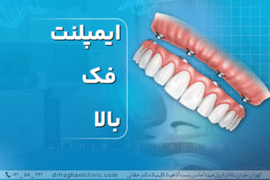 ایمپلنت فک بالا