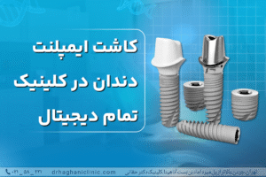 کاشت ایمپلنت در کلینیک تمام دیجیتال