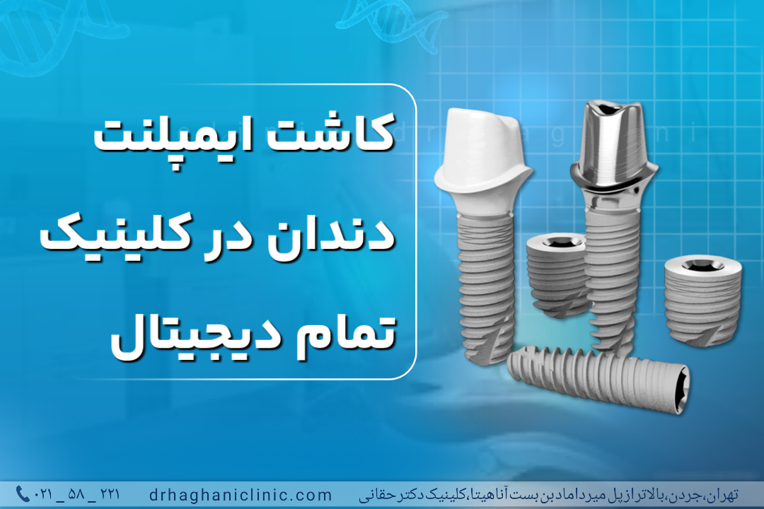 کاشت ایمپلنت در کلینیک تمام دیجیتال