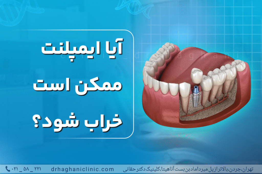 آیا ایمپلنت ممکن است خراب شود؟