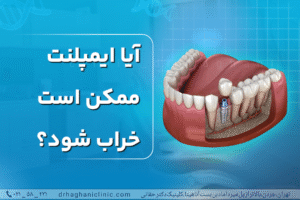 آیا ایمپلنت ممکن است خراب شود؟