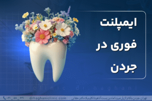 ایمپلنت فوری در تهران