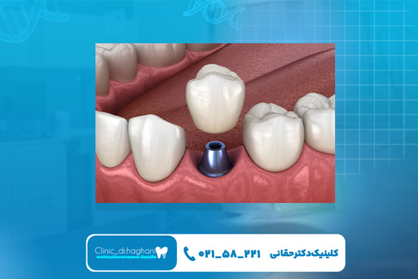 آیا ایمپلنت درد دارد؟ آیا ایمپلنت درد دارد؟