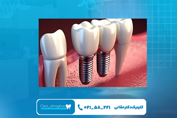 آیا ایمپلنت درد دارد؟ آیا ایمپلنت درد دارد؟