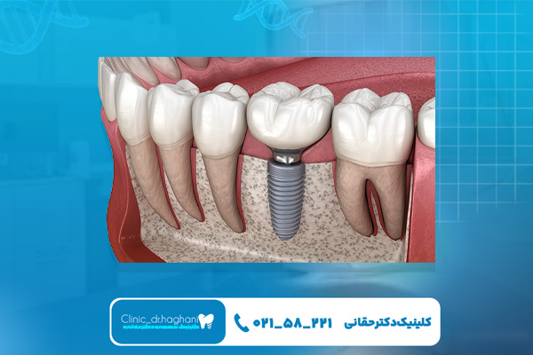 آیا ایمپلنت درد دارد؟ آیا ایمپلنت درد دارد؟