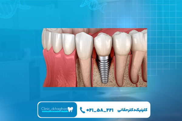 شرایط اقساطی ایمپلنت دندان شرایط اقساطی ایمپلنت دندان