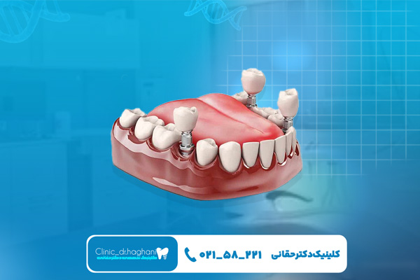 بهترین کلینیک برای کاشت دندان قسطی بهترین کلینیک برای کاشت دندان قسطی