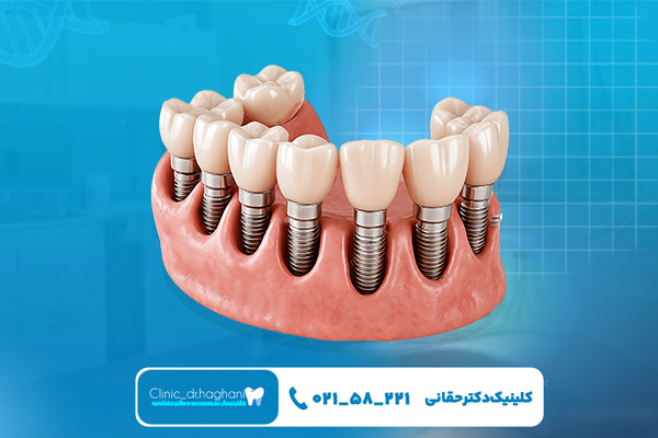 انتخاب ایمپلنت دندان و مشاوره تخصصی انتخاب ایمپلنت دندان و مشاوره تخصصی
