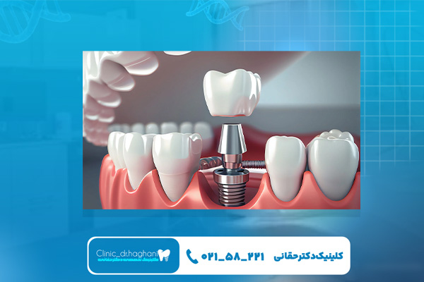 انواع برندهای کاشت دندان آلمانی انواع برندهای کاشت دندان آلمانی