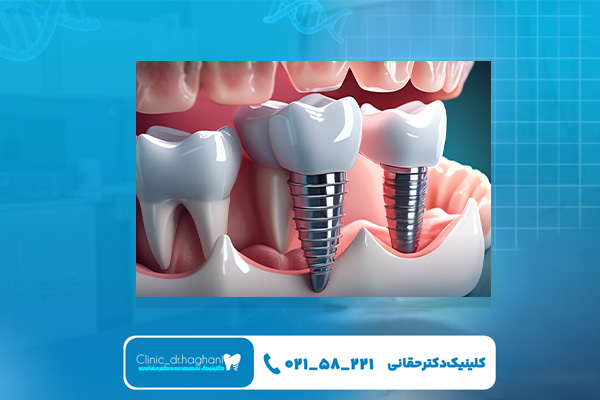 ایمپلنت آلمانی چه مزایایی دارد؟ ایمپلنت آلمانی چه مزایایی دارد؟