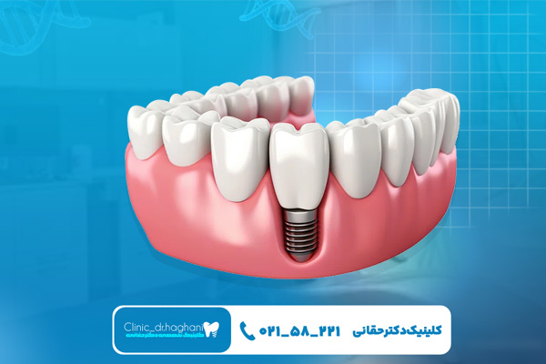 فرق ایمپلنت آمریکایی با سایر برندها