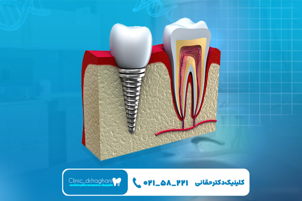 مراحل کاشت ایمپلنت آمریکایی 