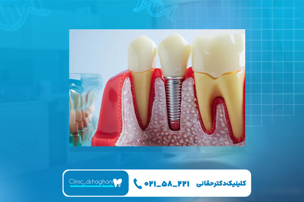 ایمپلنت آمریکایی چیست؟