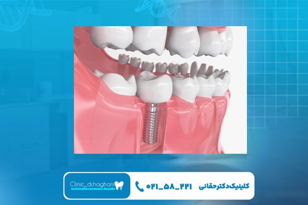 عوامل مؤثر بر هزینه ایمپلنت در تهران