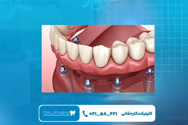 مزیتهای انجام ایمپلنت اقساطی در تهران مزیتهای انجام ایمپلنت اقساطی در تهران