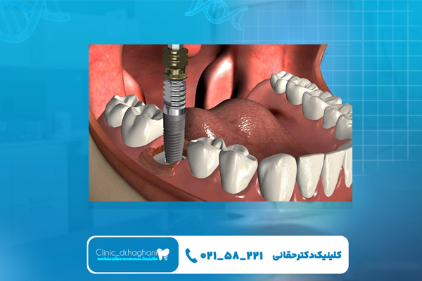 ایمپلنت اقساطی در تهران ایمپلنت اقساطی در تهران