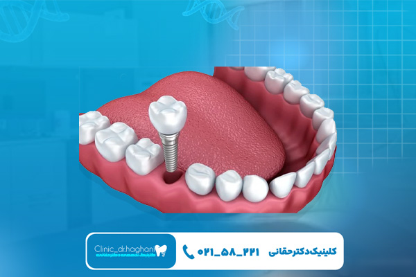 ایمپلنت اقساطی شمال تهران
