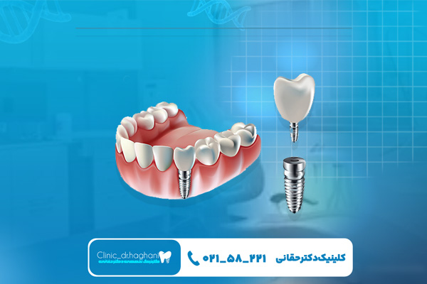 مزیت‌های کاشت ایمپلنت دندان