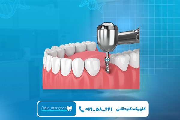 انتخاب کلینیک دندانپزشکی معتبر برای کاشت ایمپلنت