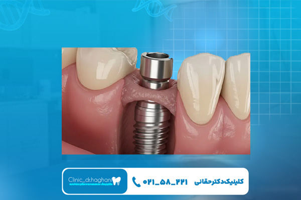 قیمت ایمپلنت بدون جراحی