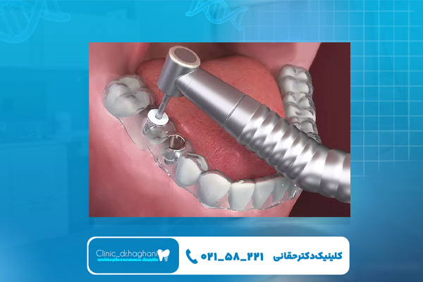 مراحل انجام ایمپلنت بدون جراحی