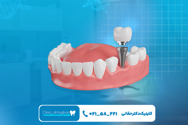 ایمپلنت بدون جراحی