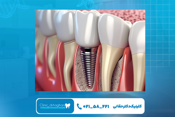 نکات مهم قبل از تصمیم به کاشت ایمپلنت در نوجوانان